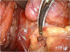 Parathyroid