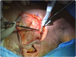 Parathyroid Surgery