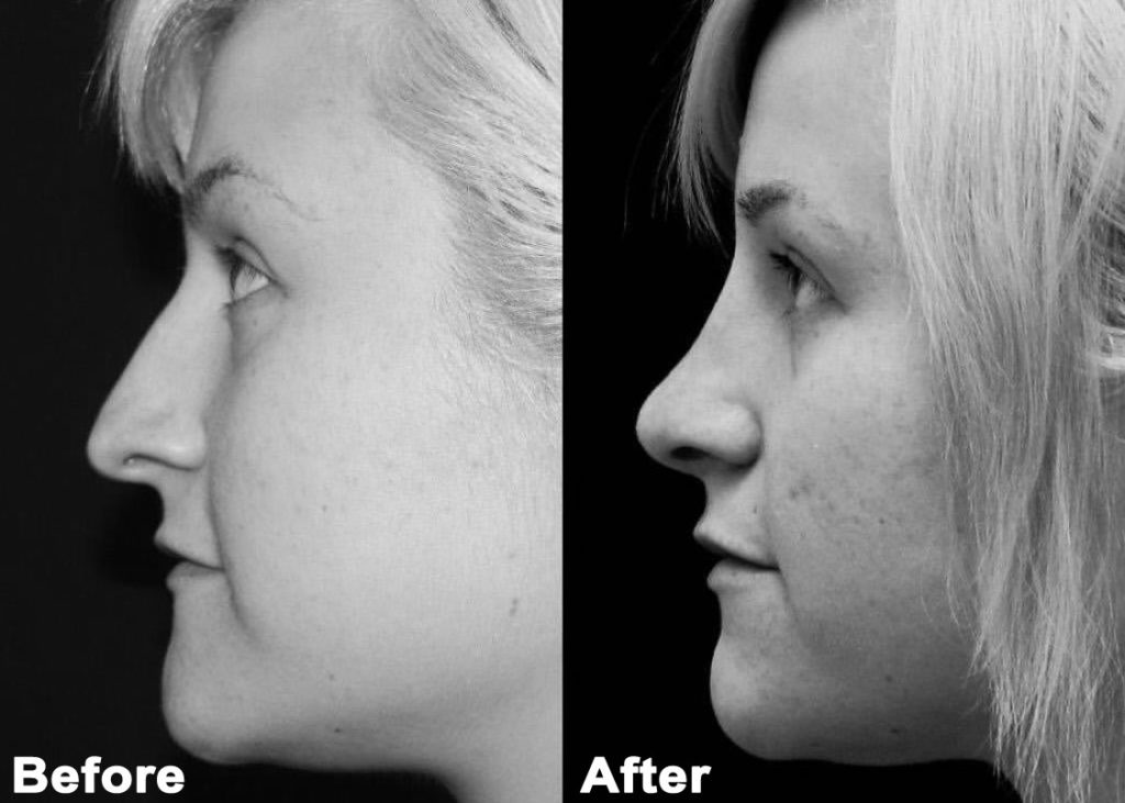 Rhinoplasty