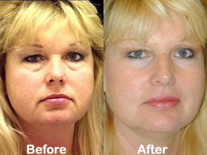 facial rejuvenation