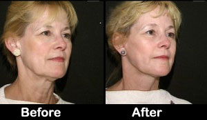 Facial Rejuvenation Procedures