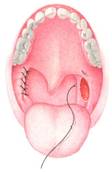 During Mouth Surgery