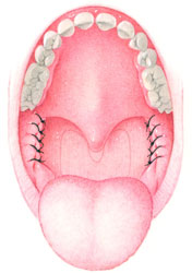 After Mouth Surgery