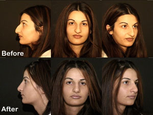 reconstructive nose surgery