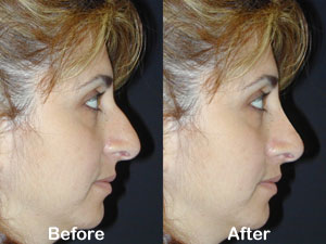 Best Rhinoplasty Surgeon in Los Angeles