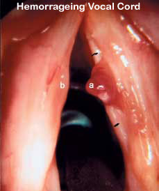 Hemorrageing-Vocal-Cord