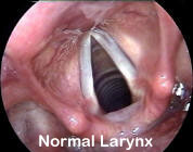 Normal-Larynx