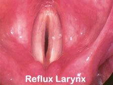 REFLUX-LARYNX