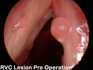 RVC-LESION-PRE-OPERATION