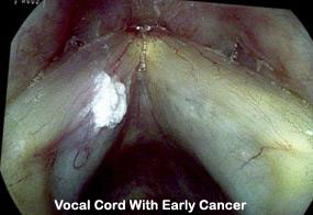 Vocal-Cord-With-Absess