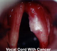 Vocal-Cord-With-Cancer