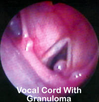 Vocal-Cord-With-Granuloma