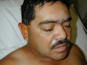 Patient recovering from forehead trauma