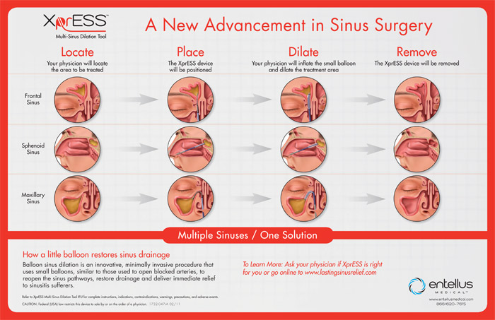 XprESS Multi-Sinus Dilation Tool