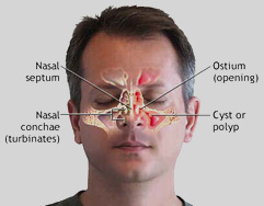 NASAL ENDOSCOPE - Sinus Treatment in Los Angeles