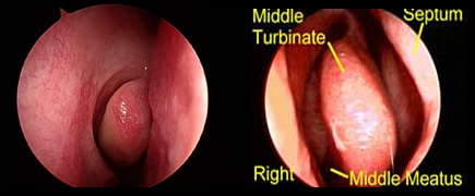 NORMAL ENDOSCOPIC VIEW OF THE INTERIOR OF THE NOSE - Sinusitis Doctor in Los Angeles