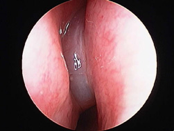 NASAL ENDOSCOPIC VIEW OF A NASAL POLYP - Sinus Treatment
