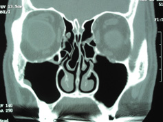 SINUS CT scan