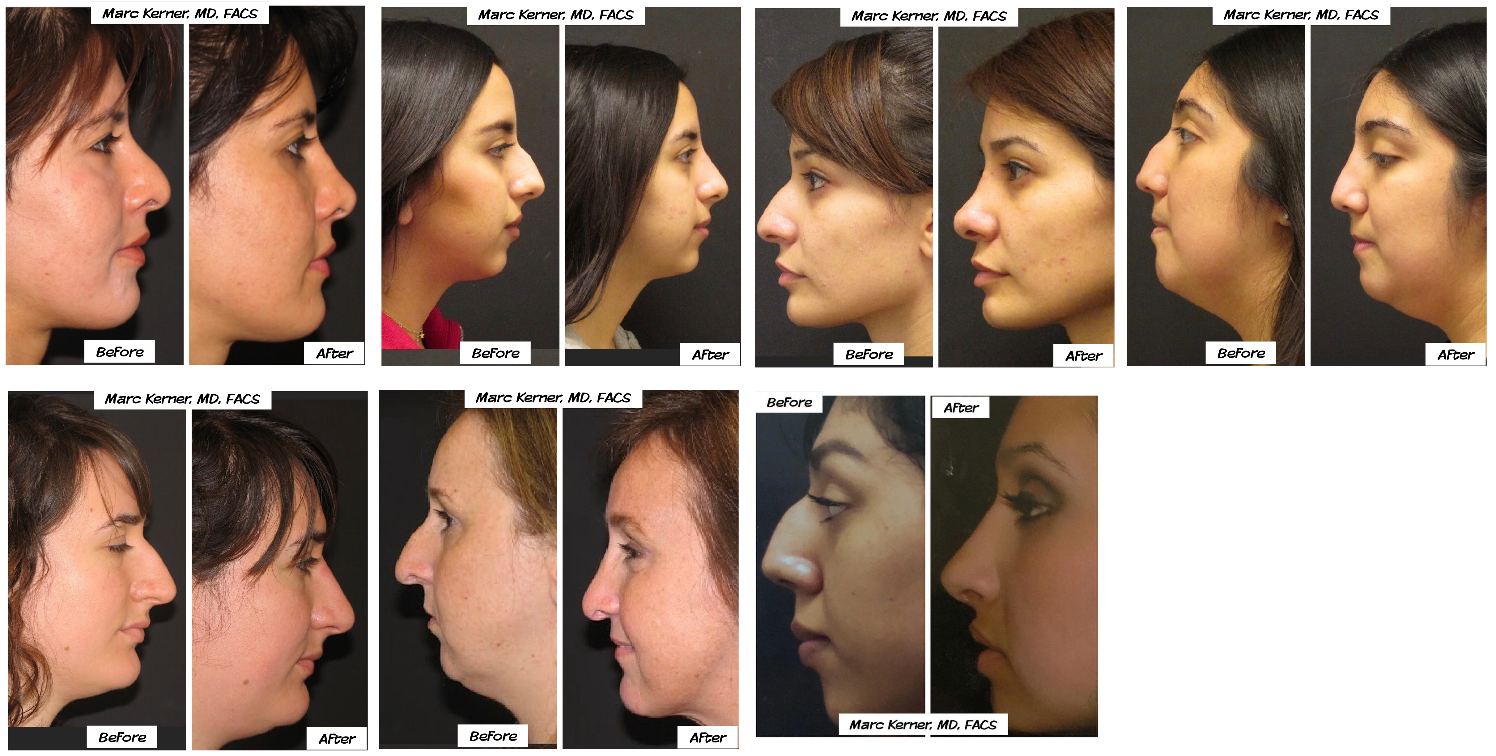 Top Rhinoplasty Surgeon in Los Angeles