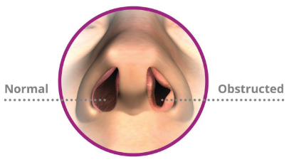 Nasal Obstruction